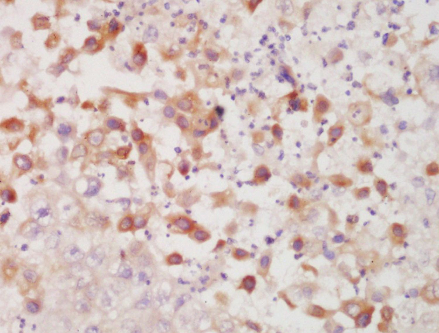 Fig2: Tissue/cell: human lung carcinoma; 4% Paraformaldehyde-fixed and paraffin-embedded;; Antigen retrieval: citrate buffer ( 0.01M, pH 6.0 ), Boiling bathing for 15min; Block endogenous peroxidase by 3% Hydrogen peroxide for 30min; Blocking buffer (normal goat serum,C-0005) at 37℃ for 20 min;; Incubation: Anti-Cytokeratin 7 Polyclonal Antibody, Unconjugated 1:200, overnight at 4℃, followed by conjugation to the secondary antibody(SP-0023) and DAB(C-0010) staining