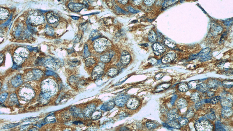 Immunohistochemistry of paraffin-embedded human breast cancer slide using Catalog No:107210(FHIT Antibody) at dilution of 1:50