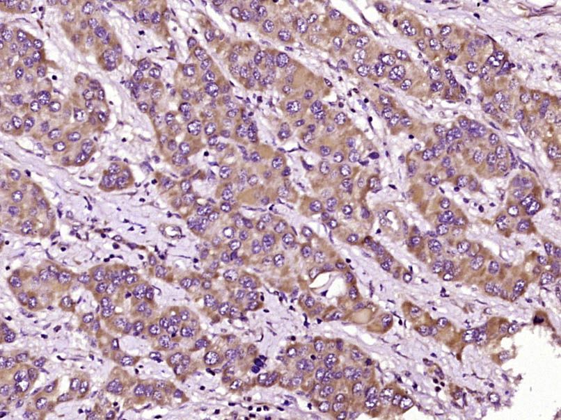 Fig2: Paraformaldehyde-fixed, paraffin embedded (Human liver carcinoma); Antigen retrieval by boiling in sodium citrate buffer (pH6.0) for 15min; Block endogenous peroxidase by 3% hydrogen peroxide for 20 minutes; Blocking buffer (normal goat serum) at 37℃ for 30min; Antibody incubation with (TRIM7) Polyclonal Antibody, Unconjugated at 1:400 overnight at 4℃, followed by operating according to SP Kit(Rabbit) (sp-0023) instructionsand DAB staining.