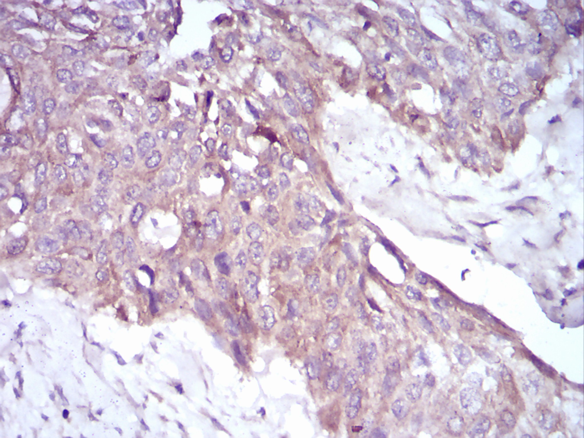 Fig2: Immunohistochemical analysis of paraffin-embedded human esophageal cancer tissue using anti-PKHD1 antibody. Counter stained with hematoxylin.