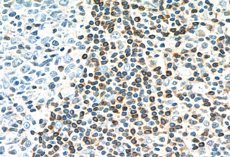 Immunohistochemistry of paraffin-embedded human tonsillitis tissue slide using Catalog No:107080(BCL2 Antibody) at dilution of 1:1000 (under 40x lens)