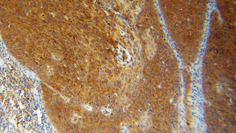 Immunohistochemical of paraffin-embedded human cervical cancer using Catalog No:109475(CORO1C antibody) at dilution of 1:100 (under 10x lens)
