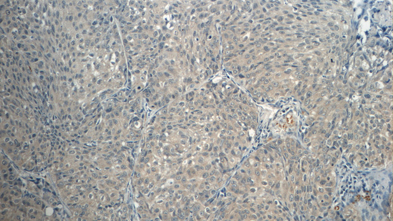 Immunohistochemistry of paraffin-embedded human lung cancer tissue slide using Catalog No:113321(ODAM Antibody) at dilution of 1:50 (under 10x lens)