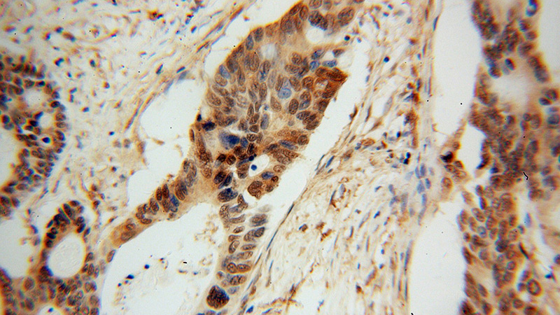 Immunohistochemical of paraffin-embedded human colon cancer using Catalog No:113670(PDE8A antibody) at dilution of 1:100 (under 40x lens)