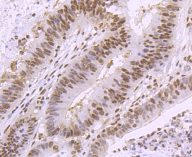 Fig6: Immunohistochemical analysis of paraffin-embedded human colon cancer tissue using anti-SMC3 antibody. Counter stained with hematoxylin.