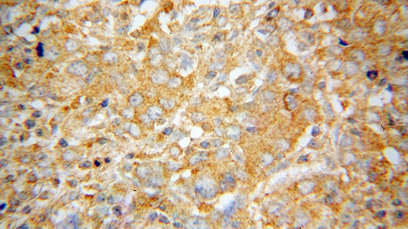 Immunohistochemical of paraffin-embedded human breast cancer using Catalog No:108240(ARD1A antibody) at dilution of 1:100 (under 40x lens)