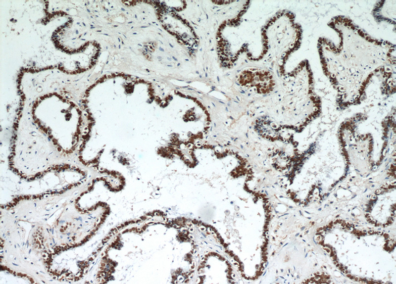 Immunohistochemical of paraffin-embedded human ovary tumor using Catalog No:113609(PAX8 antibody) at dilution of 1:50 (under 10x lens)