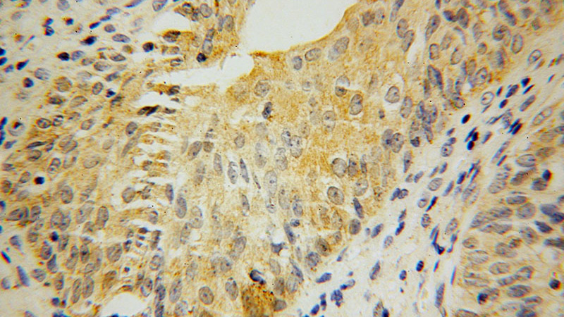 Immunohistochemical of paraffin-embedded human colon cancer using Catalog No:112777(MTHFD1L antibody) at dilution of 1:100 (under 40x lens)