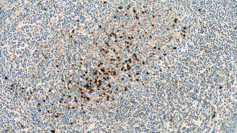 Immunohistochemistry of paraffin-embedded human tonsillitis tissue slide using Catalog No:111695(IGHD Antibody) at dilution of 1:50 (under 10x lens)