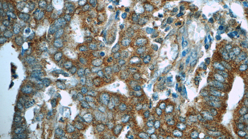 Immunohistochemistry of paraffin-embedded human endometrial cancer tissue slide using Catalog No:112642(MEK1 Antibody) at dilution of 1:50 (under 40x lens)