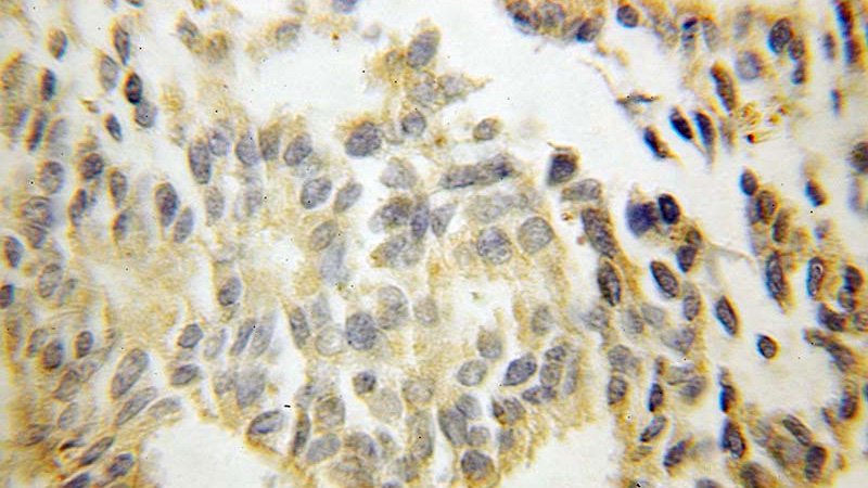 Immunohistochemical of paraffin-embedded human prostate cancer using Catalog No:113481(PRKRA antibody) at dilution of 1:100 (under 40x lens)