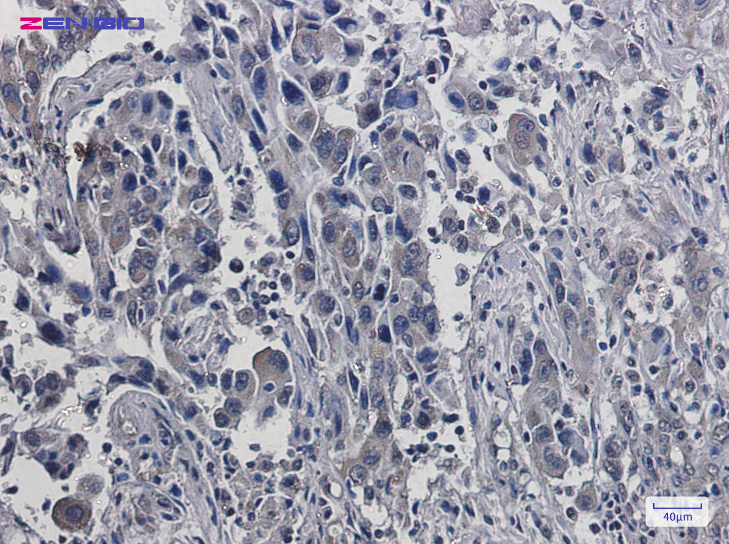 Immunohistochemistry of eIF4E in paraffin-embedded Human lung cancer tissue using eIF4E Rabbit pAb at dilution 1/20