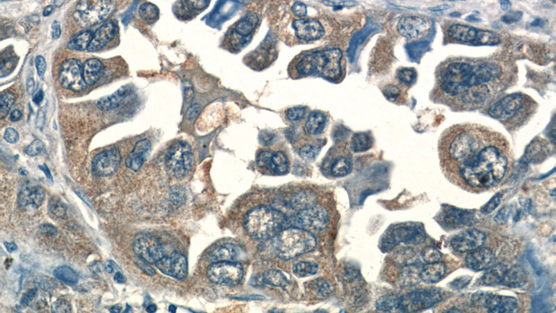 Immunohistochemistry of paraffin-embedded human lung cancer tissue slide using Catalog No:107511(RRM1 Antibody) at dilution of 1:50