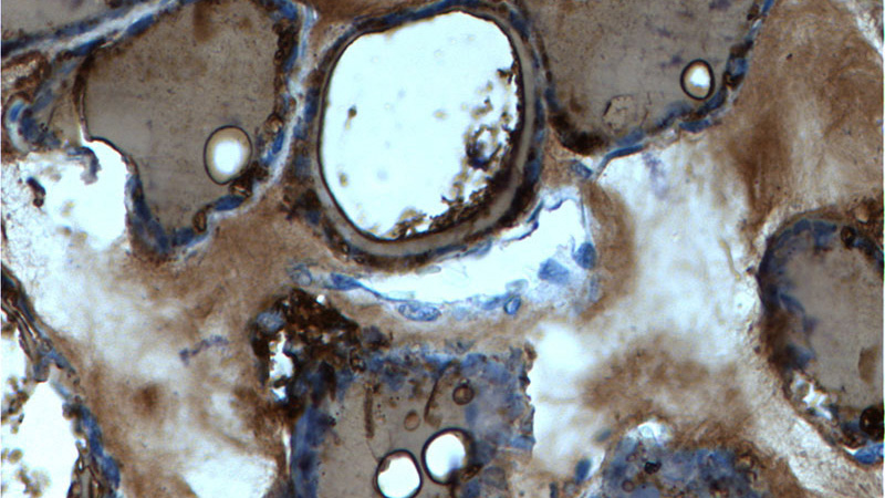 Immunohistochemistry of paraffin-embedded human thyroid tissue slide using Catalog No:107623(TG Antibody) at dilution of 1:200 (under 40x lens).
