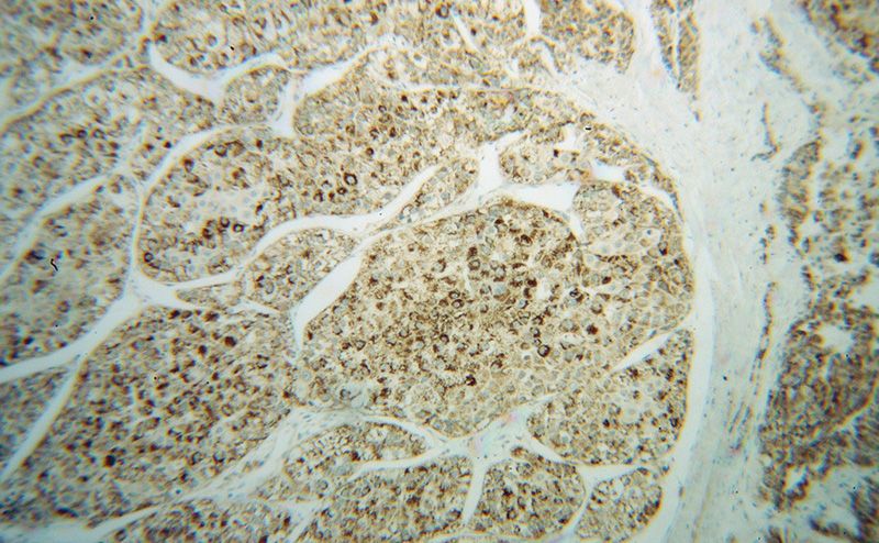 Immunohistochemical of paraffin-embedded human liver cancer using Catalog No:113260(NNT antibody) at dilution of 1:50 (under 10x lens)