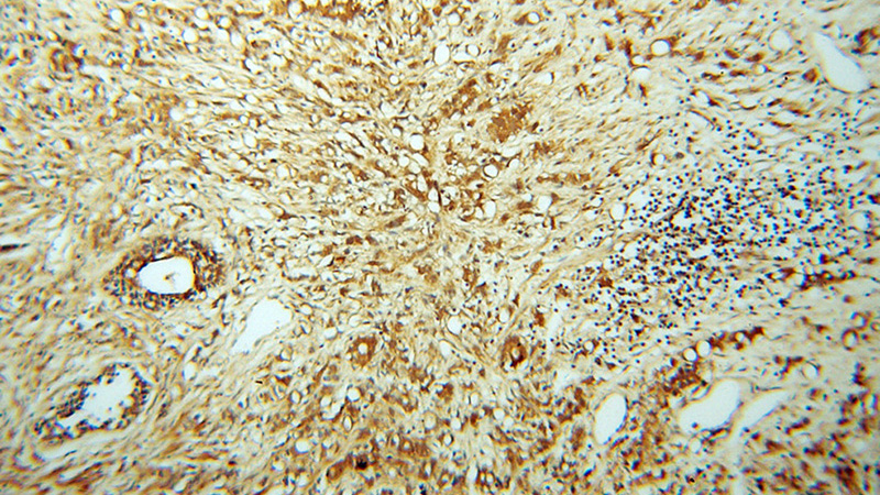 Immunohistochemical of paraffin-embedded human prostate cancer using Catalog No:114494(RABEP2 antibody) at dilution of 1:100 (under 10x lens)