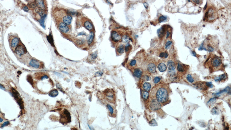 Immunohistochemical of paraffin-embedded human breast cancer using Catalog No:108888(CTSD antibody) at dilution of 1:50 (under 40x lens)