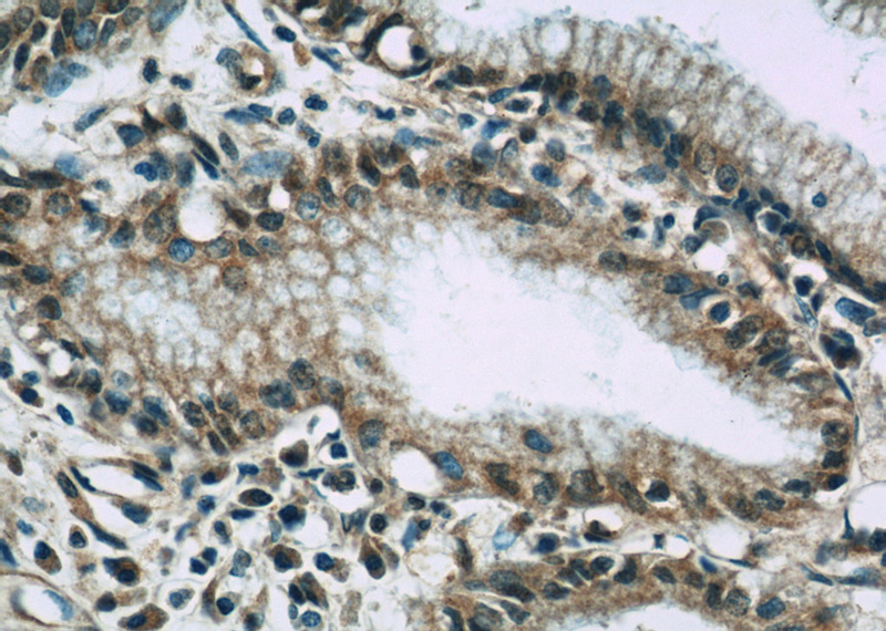 Immunohistochemistry of paraffin-embedded human pancreas cancer slide using Catalog No:116766(VNN1 Antibody) at dilution of 1:50(under 40x lens)