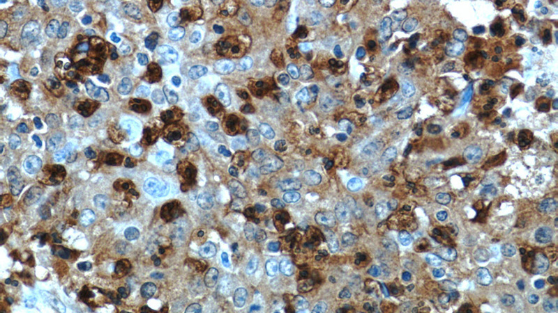 Immunohistochemistry of paraffin-embedded human colon cancer tissue slide using Catalog No:114956(S100A12 Antibody) at dilution of 1:50 (under 40x lens)