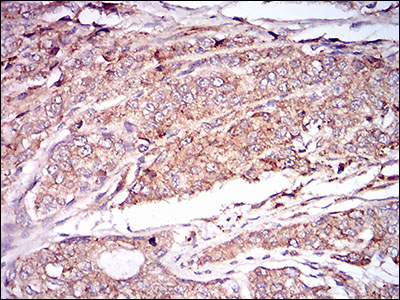 Immunohistochemical analysis of paraffin-embedded prostate cancer tissues using CAMK2G mouse mAb with DAB staining.