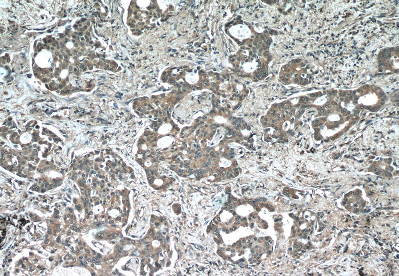 Immunohistochemistry of paraffin-embedded human lung cancer tissue slide using Catalog No:107557(TUBA1A(ace-40Lys) Antibody) at dilution of 1:50 (under 10x lens)
