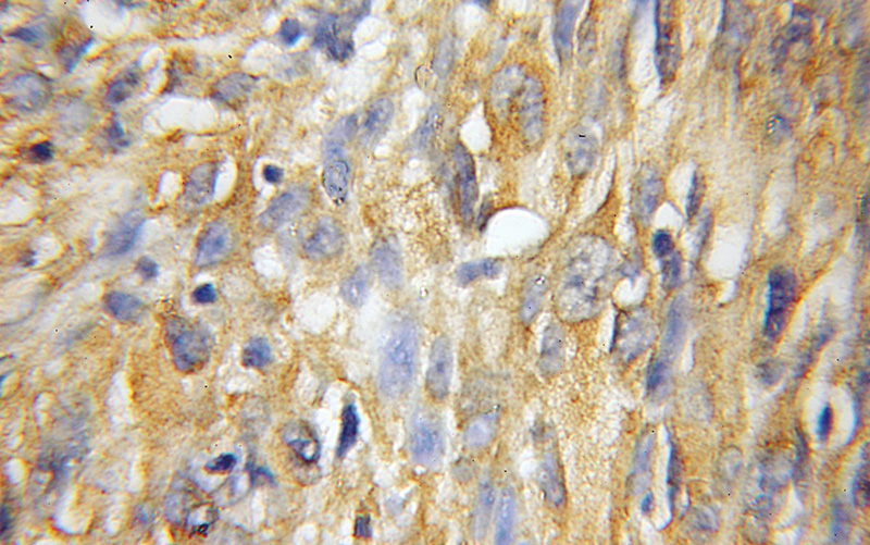 Immunohistochemical of paraffin-embedded human gliomas using Catalog No:112885(MTX2 antibody) at dilution of 1:50 (under 10x lens)