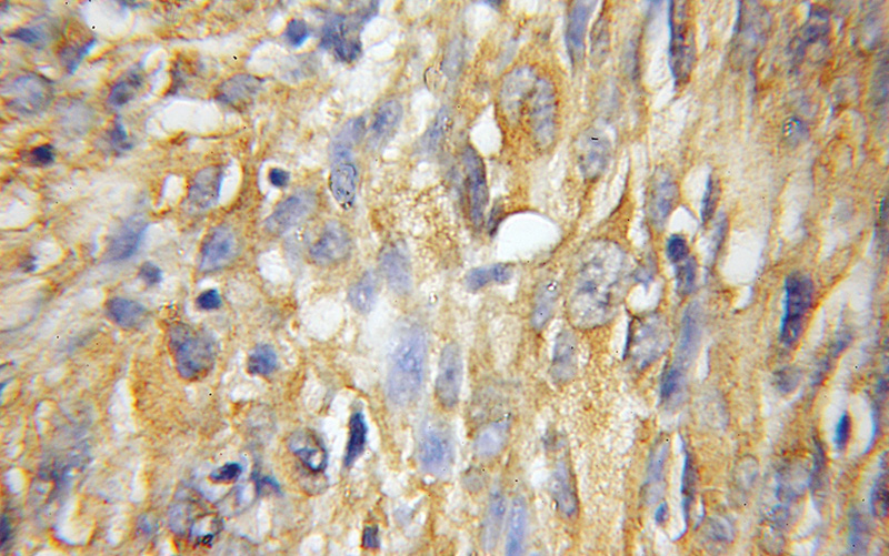 Immunohistochemical of paraffin-embedded human gliomas using Catalog No:112885(MTX2 antibody) at dilution of 1:50 (under 10x lens)