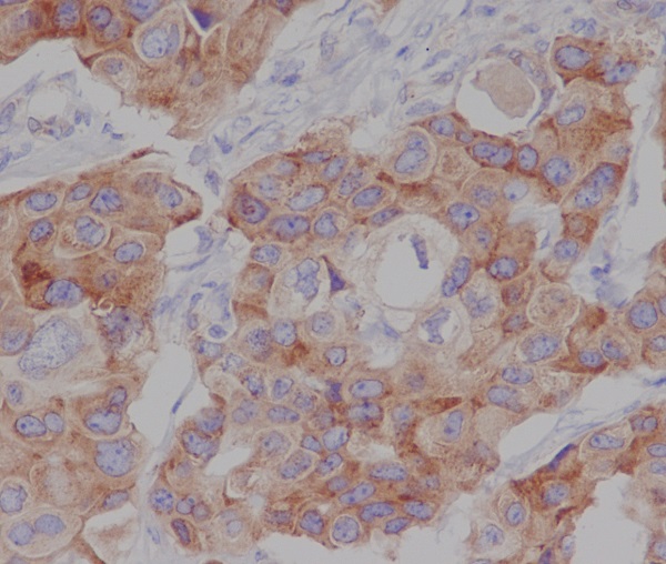 Immunohistochemical analysis of paraffin-embedded human breast cancer, using Phospho-mTOR (S2448) Antibody.