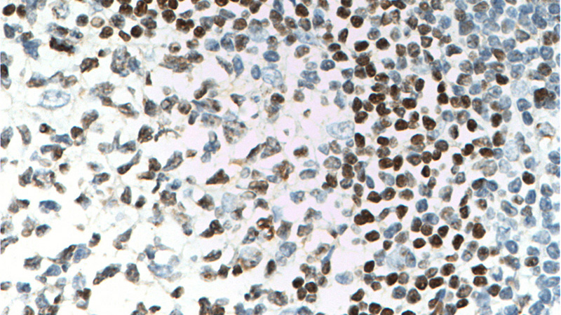 Immunohistochemistry of paraffin-embedded human tonsillitis tissue slide using Catalog No:117248(BSAP,PAX5 Antibody) at dilution of 1:100 (under 40x lens). heat mediated antigen retrieved with Sodium Citrate buffer (pH6).
