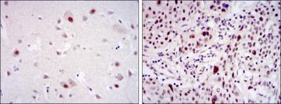 Immunohistochemical analysis of paraffin-embedded brain tissues (left) and esophageal cancer tissues (right) using CDK9 mouse mAb with DAB staining.