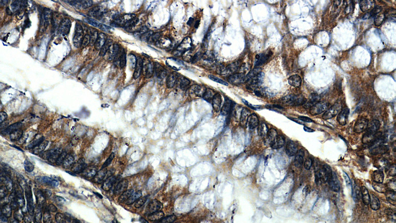 Immunohistochemistry of paraffin-embedded human colon slide using Catalog No:114217(PHB2 Antibody) at dilution of 1:50
