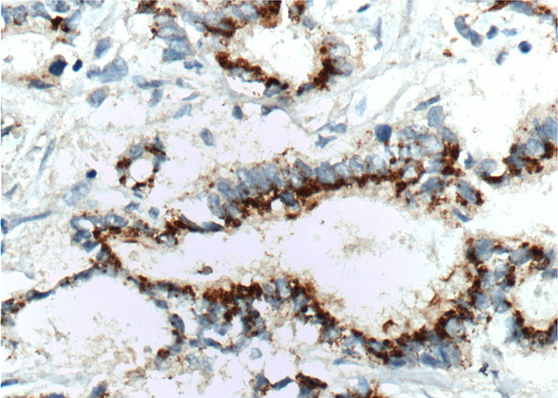 Immunohistochemistry of paraffin-embedded human pancreas cancer tissue slide using Catalog No:107378(IL10 Antibody) at dilution of 1:200 (under 40x lens). heat mediated antigen retrieved with Tris-EDTA buffer(pH9).
