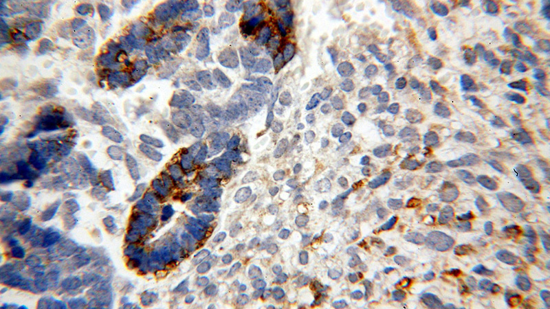 Immunohistochemical of paraffin-embedded human ovary tumor using Catalog No:112685(MLN64,STARD3 antibody) at dilution of 1:200 (under 40x lens)