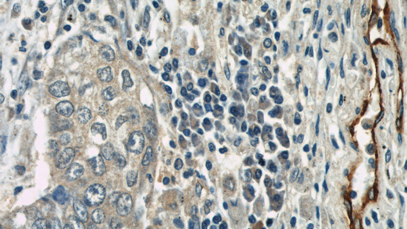 Immunohistochemical of paraffin-embedded human lung cancer using Catalog No:114298(SELP antibody) at dilution of 1:50 (under 40x lens)