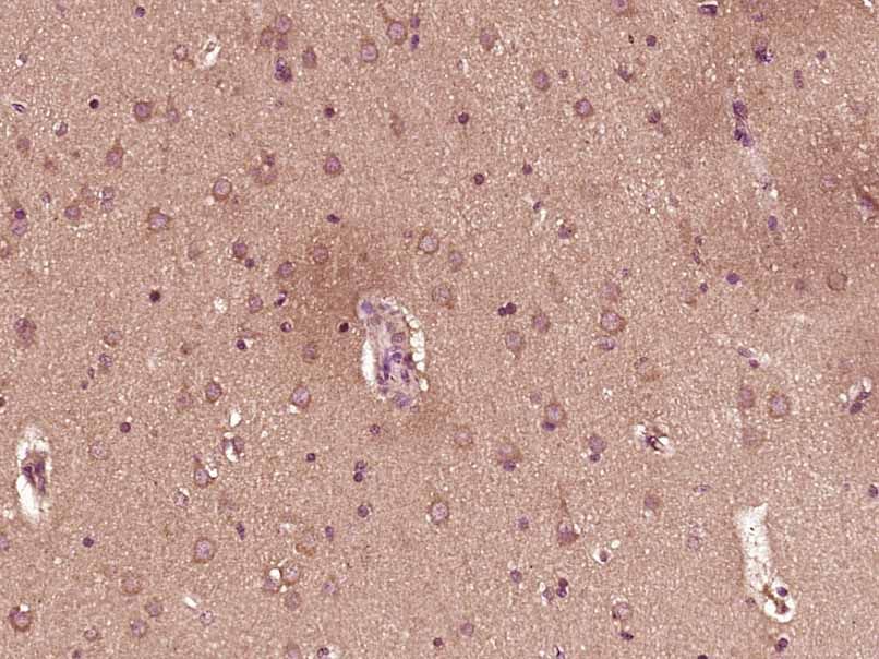 Fig5: Paraformaldehyde-fixed, paraffin embedded (Human brain glioma); Antigen retrieval by boiling in sodium citrate buffer (pH6.0) for 15min; Block endogenous peroxidase by 3% hydrogen peroxide for 20 minutes; Blocking buffer (normal goat serum) at 37℃ for 30min; Antibody incubation with (TIMP-1) Polyclonal Antibody, Unconjugated at 1:500 overnight at 4℃, followed by a conjugated secondary (sp-0023) for 20 minutes and DAB staining.