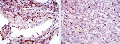 Immunohistochemical analysis of paraffin-embedded endometrial cancer tissues (left) and cervical cancer tissues (right) using GRK2 mouse mAb with DAB staining.