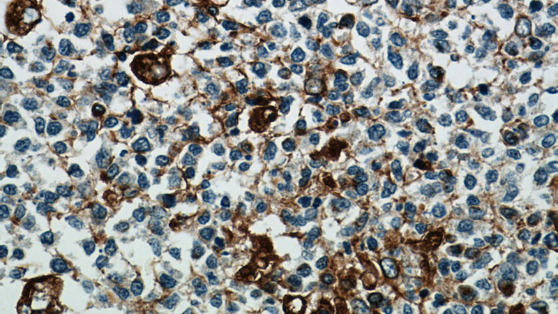 Immunohistochemical of paraffin-embedded human tonsillitis using Catalog No:116753(VIM antibody) at dilution of 1:50 (under 40x lens)