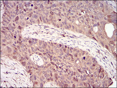 Immunohistochemical analysis of paraffin-embedded cervical cancer tissues using CCNA2 mouse mAb with DAB staining.
