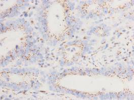 Fig2: Immunohistochemical analysis of paraffin- embedded gastric cancer tissue using anti-GOLGA5 Mouse mAb (Cat. # 176644#).