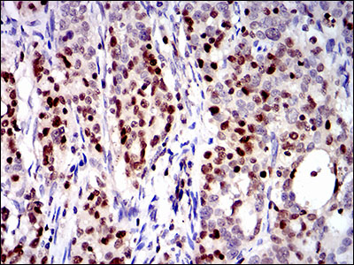 Immunohistochemical analysis of paraffin-embedded cervical cancer tissues using RUNX3 mouse mAb with DAB staining.