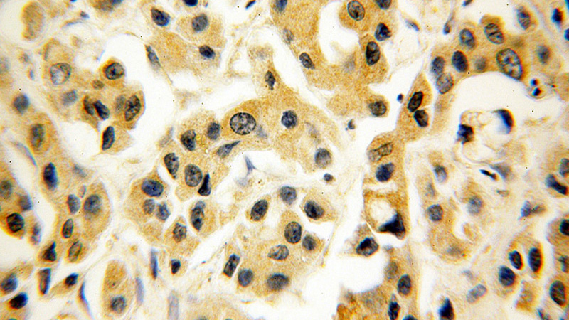Immunohistochemical of paraffin-embedded human breast cancer using Catalog No:108866(CSNK1E antibody) at dilution of 1:50 (under 40x lens)
