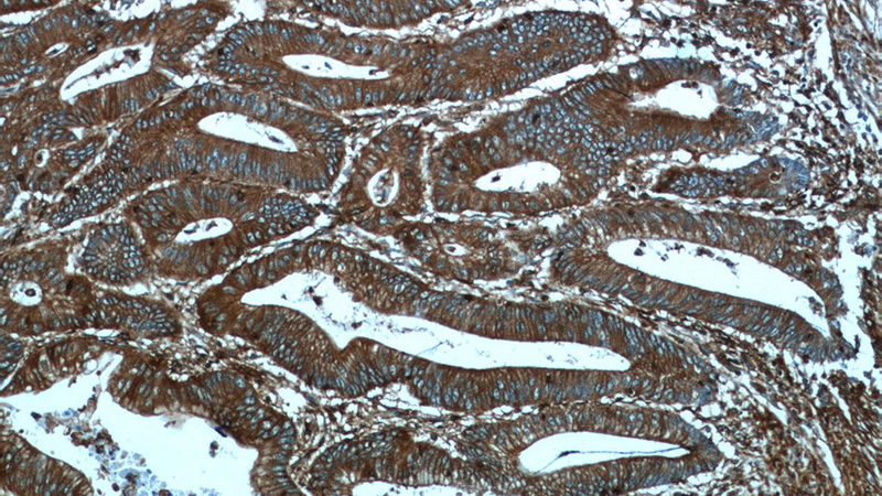 Immunohistochemistry of paraffin-embedded human colon cancer tissue slide using Catalog No:113503(PALLD,palladin Antibody) at dilution of 1:50 (under 10x lens)