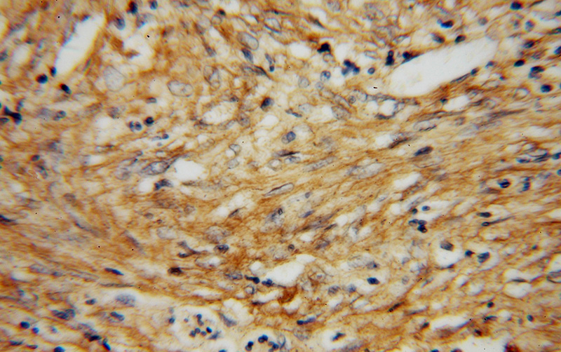 Immunohistochemical of paraffin-embedded human colon cancer using Catalog No:110659(FN1 antibody) at dilution of 1:50 (under 40x lens)