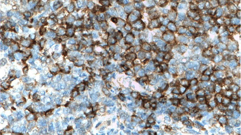 Immunohistochemistry of paraffin-embedded human tonsillitis tissue slide using Catalog No:107053(CD22 Antibody) at dilution of 1:400 (under 40x lens). heat mediated antigen retrieved with Tris-EDTA buffer(pH9).