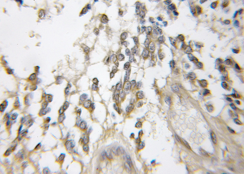 Immunohistochemical of paraffin-embedded human gliomas using Catalog No:109494(COX6B1 antibody) at dilution of 1:50 (under 10x lens)