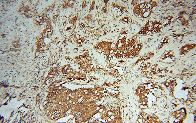 Immunohistochemical of paraffin-embedded human prostate cancer using Catalog No:113529(OXSR1 antibody) at dilution of 1:100 (under 10x lens)