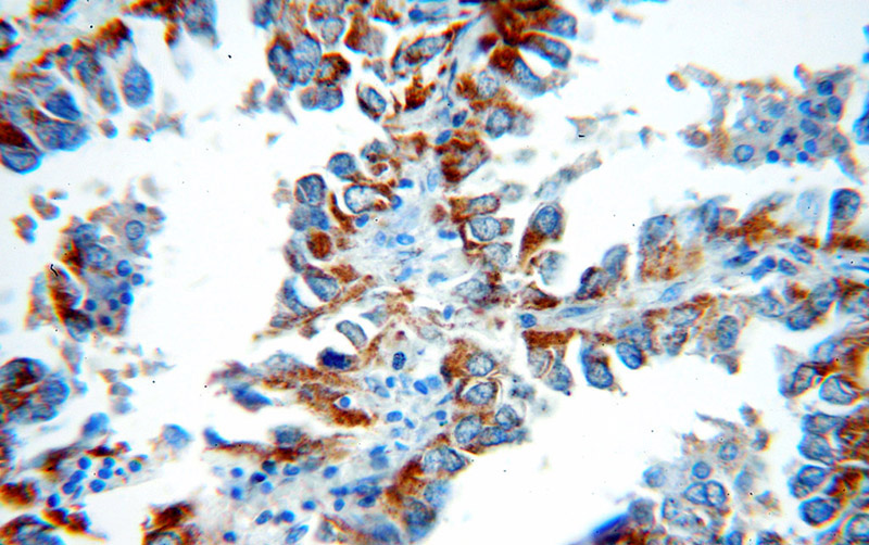 Immunohistochemical of paraffin-embedded human lung cancer using Catalog No:115621(IL1RL1 antibody) at dilution of 1:50 (under 40x lens)
