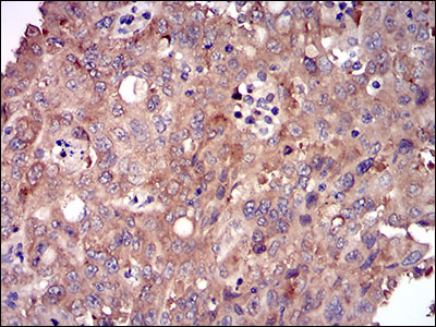 Fig4: Immunohistochemical analysis of paraffin-embedded human endometrial cancer tissue using anti-DIS3L2 antibody. Counter stained with hematoxylin.