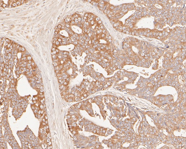 Fig2:; Immunohistochemical analysis of paraffin-embedded human prostate carcinoma tissue using anti-GADD34 antibody. The section was pre-treated using heat mediated antigen retrieval with Tris-EDTA buffer (pH 8.0-8.4) for 20 minutes.The tissues were blocked in 5% BSA for 30 minutes at room temperature, washed with ddH; 2; O and PBS, and then probed with the primary antibody ( 1/100) for 30 minutes at room temperature. The detection was performed using an HRP conjugated compact polymer system. DAB was used as the chromogen. Tissues were counterstained with hematoxylin and mounted with DPX.
