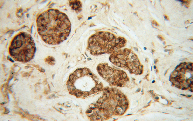 Immunohistochemical of paraffin-embedded human breast cancer using Catalog No:113762(PDAP1 antibody) at dilution of 1:50 (under 40x lens)